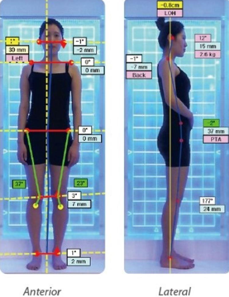 척추측만증_무료검진1